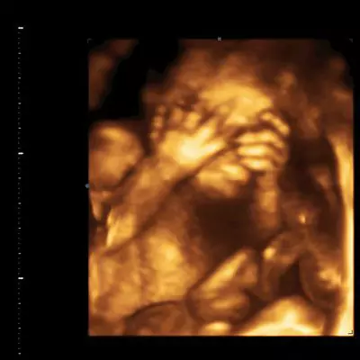 Showing example of a 3D Ultrasound