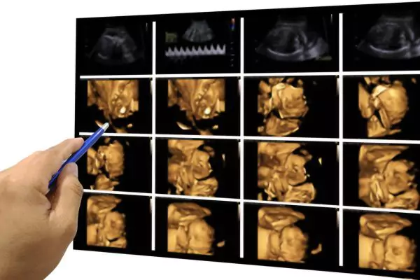 Person pointing at a 4D Ultrasound image