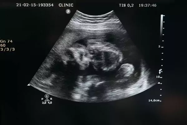 Ultrasound of baby in womb